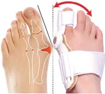 ⁦סד Hallux Valgus (בוהן עקומה)⁩ – תמונה ⁦2⁩