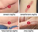 ⁦קרם סיליקון להפחתת צלקות anti scar, שיפור מראה צלקת ועור והחלמה מהירה⁩ – תמונה ⁦4⁩