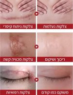 ⁦קרם סיליקון להפחתת צלקות anti scar, שיפור מראה צלקת ועור והחלמה מהירה⁩ – תמונה ⁦3⁩